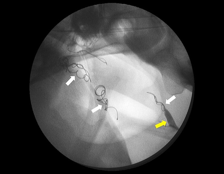 Luftsackmykose: Durchleuchtungsbild nach Verschluss beschädigter Blutgefäße mit Coils (weiße Pfeile). Das mit Kontrastmittel angereicherte Blut (Gelber Pfeil) kann die Arterie nicht mehr verlassen.