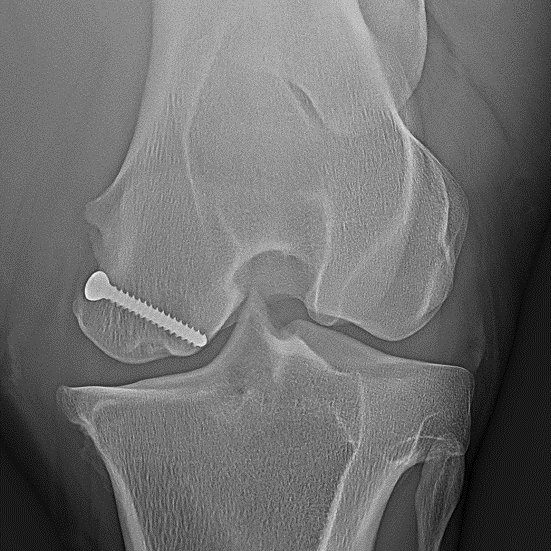 Mit Zugschraube behandelte "Knie-Zyste"