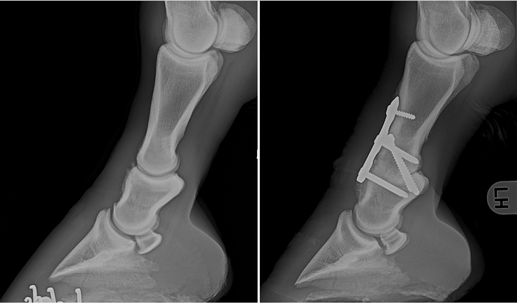 Arthrose des Krongelenks (Schale) vor und nach Gelenkversteifung (Arthrodese)