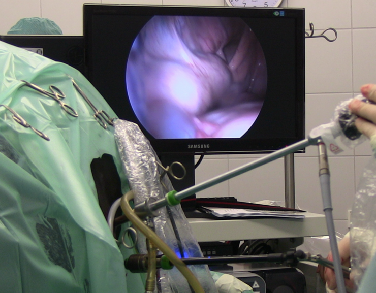 Durchführung einer Laparoskopie