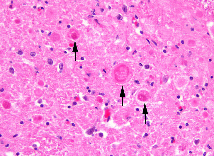Neuroaxonale Dystrophie mit Nachweis von Autophagosomen gefüllten Sphäroiden (Pfeile) im Rückenmark eines Hundes. Foto: P. Wohlsein