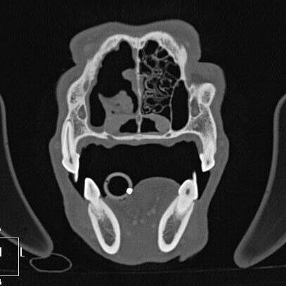 Aspergillose im CT