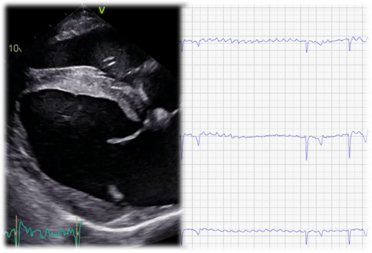 -	Herzultraschall (links) und EKG (rechts) eines Patienten mit Vorhofflimmern