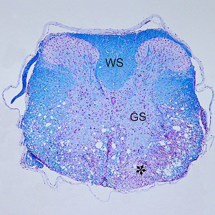PM140129_Multiple_Sklerose_Entmarkung_02.jpg