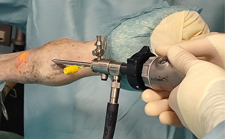 Sehnenscheidenspiegelung in Narkose