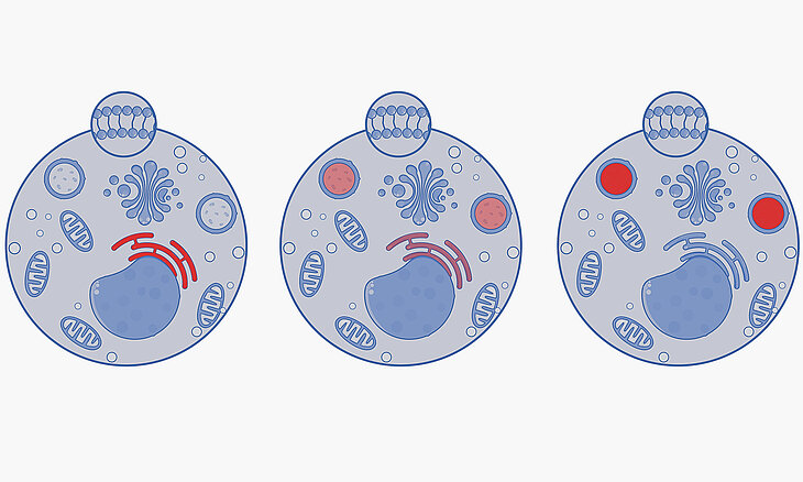 Verteilung der NPC1-Proteine (orange) in der Zelle: In Gruppe 1 befinden sich die Proteine nur im endoplasmatischen Retikulum (links). In Gruppe 2 befinden sie sich zusätzlich noch in den Lysosomen (Mitte). In Gruppe 3 zeigt das NPC1-Protein ein normales Verteilungsmuster in der Zelle (rechts). Abbildung: Molecular Sensei, Shutterstock.com