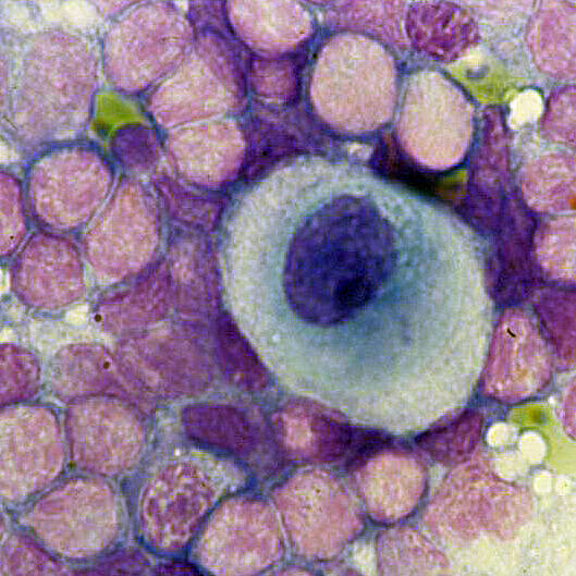 Tumorzelle im Lyphknotenpraeparat