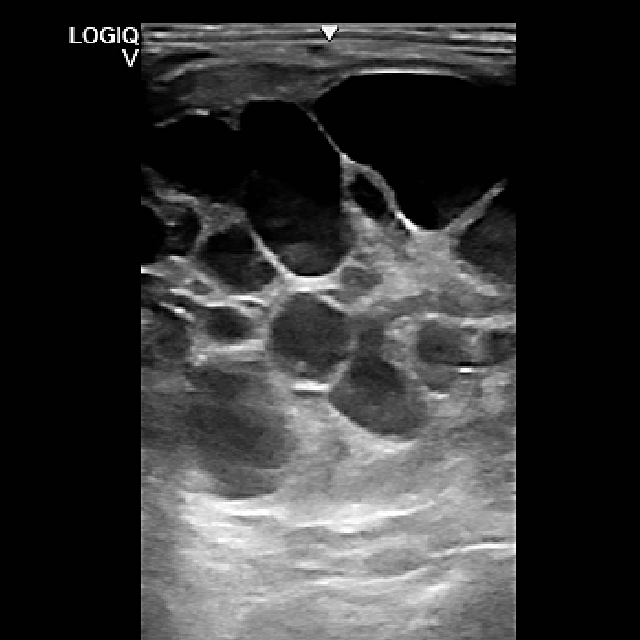 Ultraschallbild eines tumorös veränderten Eierstockes