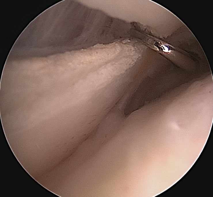 Endoskopische Durchtrennung des Fesselringbandes