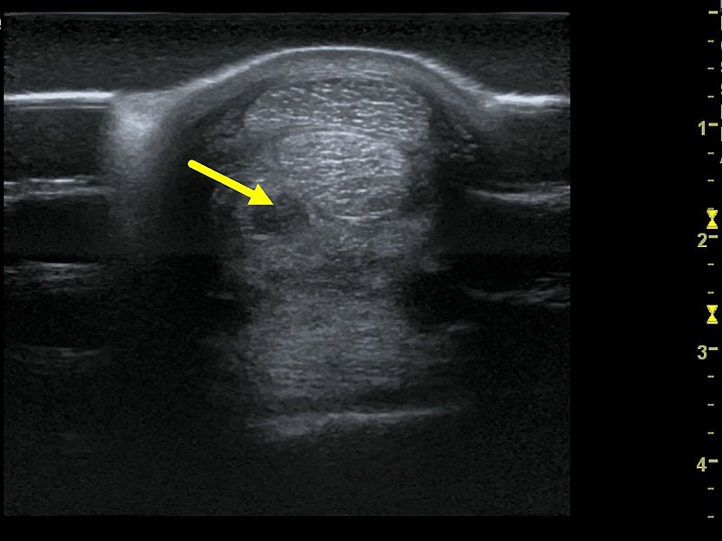Ultraschalluntersuchung einer Sehne der Vordergliedmaße - der Pfeil zeigt eine Läsion im Unterstützungsband der tiefen Beugesehne